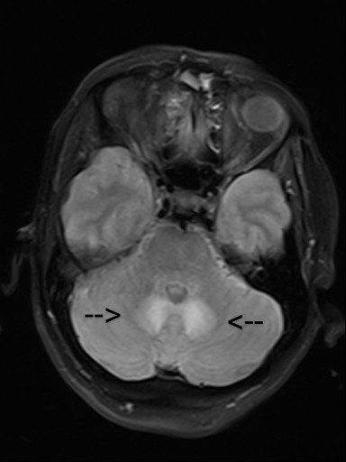 Pouria Moshayedi, MD PhD (@pouriamoshayedi) on Twitter photo T2 hyperintensity of dentate nuclei (arrows) in a patient with metronidazole-induced encephalopathy.
Courtesy of Dr Abbas Tafakhori, IIKHC, <a href="/TehUofMed/">Tehran University of Medical Sciences</a> T2 hyperintensity of dentate nuclei (arrows) in a patient with metronidazole-induced encephalopathy.
Courtesy of Dr Abbas Tafakhori, IIKHC, <a href="/TehUofMed/">Tehran University of Medical Sciences</a>