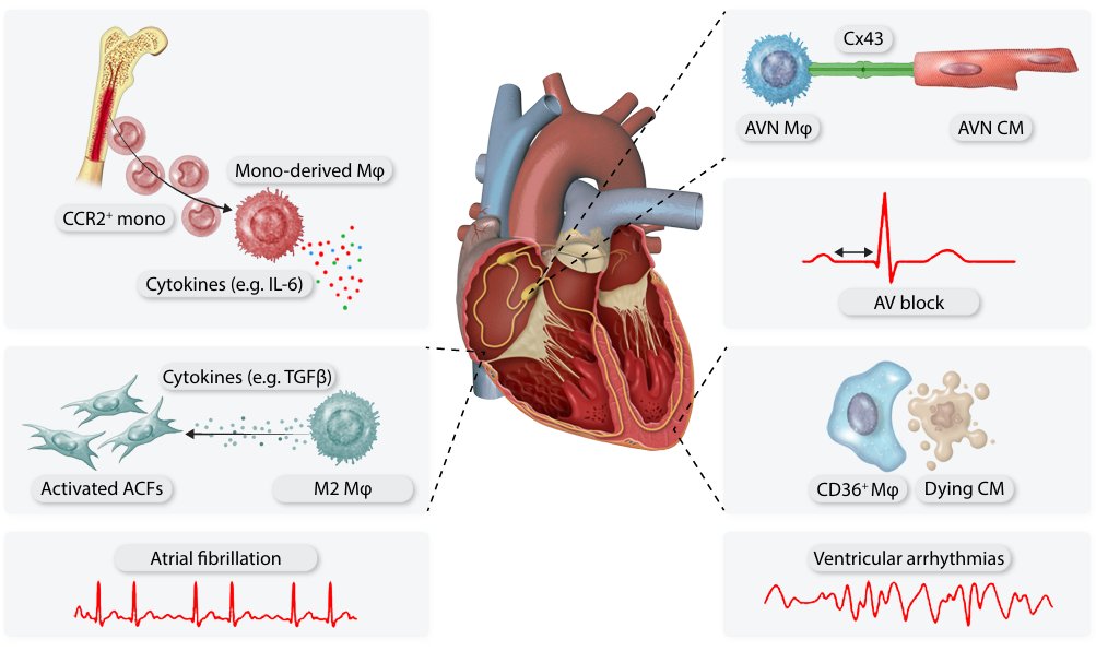 Inflaming #cardiac arrhythmias ❤️‍🔥
Must-read comprehensive review of the role immune cells play in driving atrial and ventricular #arrhythmias
ow.ly/lIyw50VCp6X

<a href="/CVR_TomaszGuzik/">CVR Tomasz Guzik</a> <a href="/glenpyle/">Glen Pyle | #WomensHeartHealth ❤️‍🩹🖇️</a> <a href="/DrMikeDrozd/">Mike Drozd</a> <a href="/Sarah_KBrown/">Sarah Brown</a> #CardioTwitter #CardioImmunology #CardiovascularResearch
