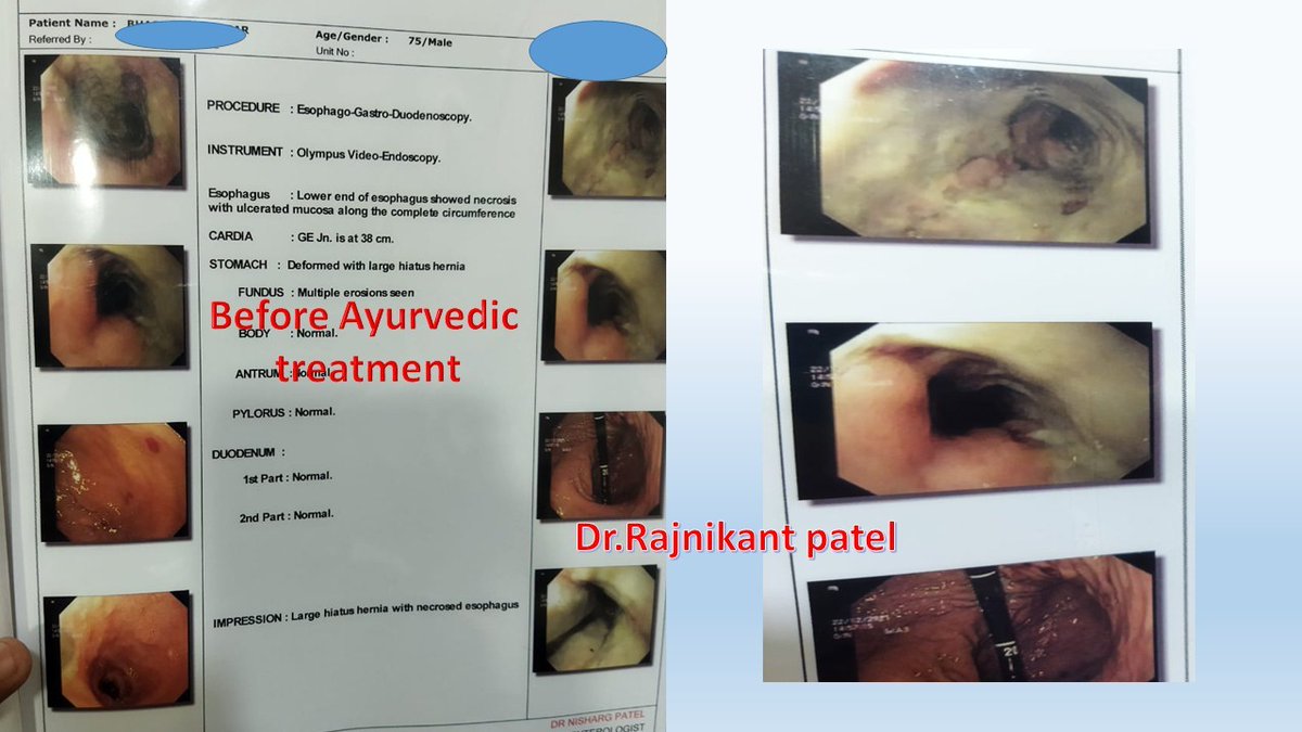 Rajnikant0257's tweet photo. Oesophagus Necrosis treated with Ayurvedic treatment

Special Tweet for Anti AYUSH lobby and so called Intelligent people who say Ayurved is Pseudoscience..

Enjoy the tweet and good luck with verbal diarrhoea🤣🤣

#Ayurveda https://t.co/HwGBjrIWij