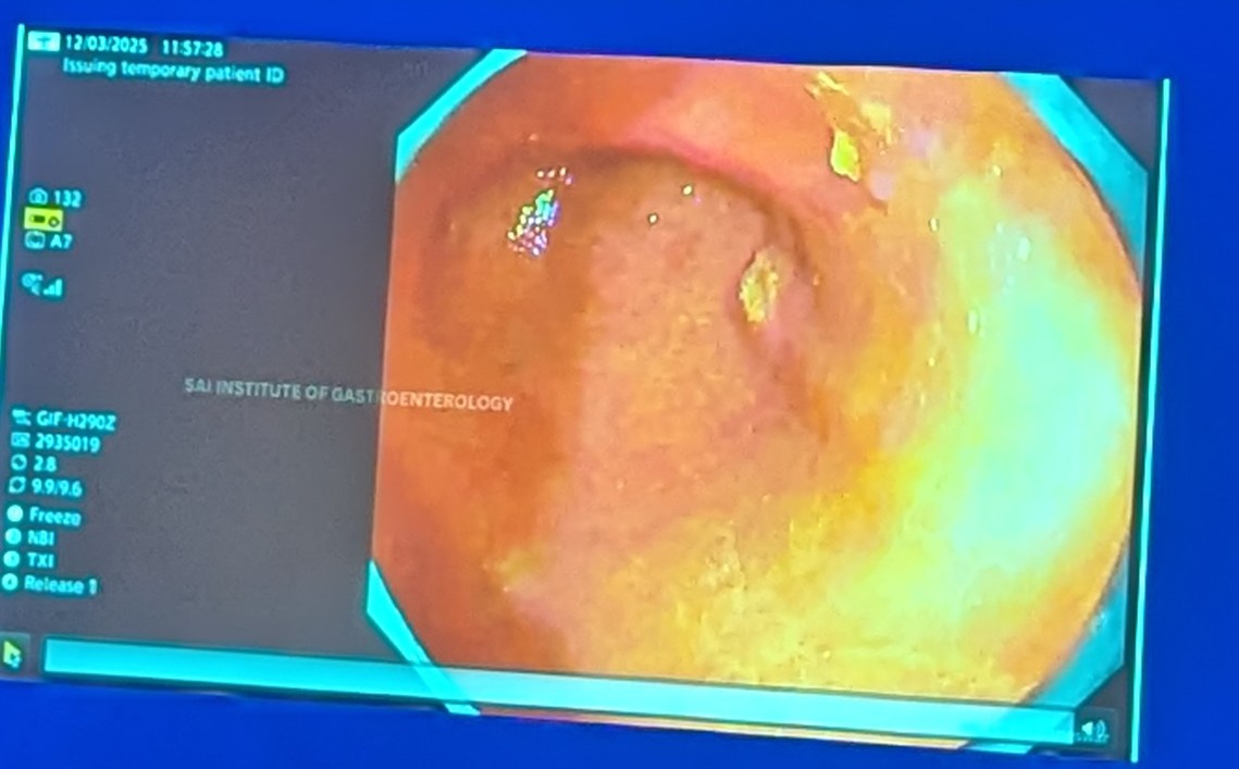 Srisha Hebbar (@srisha_hebbar) on Twitter photo Examine carefully when you see gastric xanthomas.
Xanthomas are associated with increased risk of gastric cancer & precancerous Amazing videos of early Gastric cancer by Ashutosh Mohapatra. #Mumbailive2025 <a href="/MaydeoAmit/">Amit Maydeo</a> <a href="/amolbapaye/">Amol Bapaye</a> <a href="/Nareshbhat14/">Naresh bhat</a> <a href="/gastro3570/">Pradeep Bhandari</a> #GItwitter Examine carefully when you see gastric xanthomas.
Xanthomas are associated with increased risk of gastric cancer & precancerous Amazing videos of early Gastric cancer by Ashutosh Mohapatra. #Mumbailive2025 <a href="/MaydeoAmit/">Amit Maydeo</a> <a href="/amolbapaye/">Amol Bapaye</a> <a href="/Nareshbhat14/">Naresh bhat</a> <a href="/gastro3570/">Pradeep Bhandari</a> #GItwitter