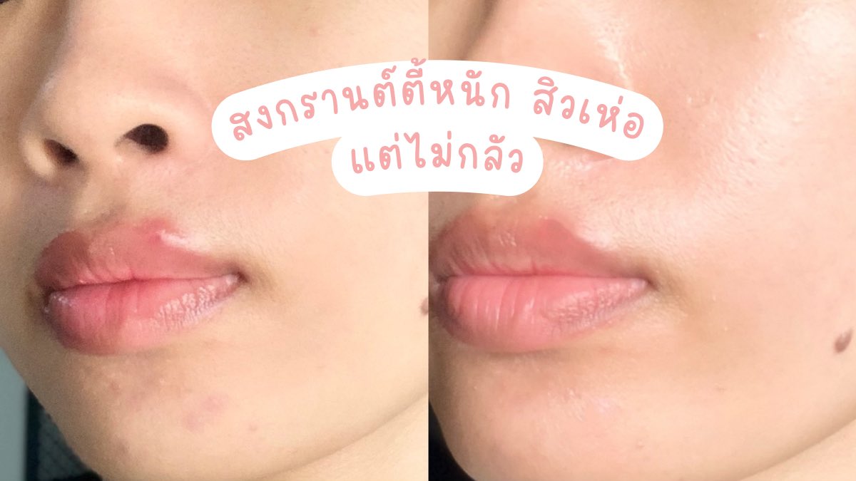 ปีใหม่ หน้าใหม่ หน้าใสไร้สิวหลังสงกรานต์💦 #JellyMeZinc ไอเทม #ลดสิว ประโยชน์เต็มซอง อร่อย หอมกลิ่นพีช🍑 น้ำตาล 0% ยิ่งแช่เย็นยิ่งอร่อย ซัมเมอร์นี้ต้องมีติดตู้เย็น ราคาน่ารัก ซองละ 20.- เองแกกกก หาซื้อได้แล้วที่ร้านสะดวกซื้อ

#JellyMe #JellyMeCuti #ความคิวทิบิลด์ง่ายได้ทุกวัน #ลดสิว #HowtoPerfect