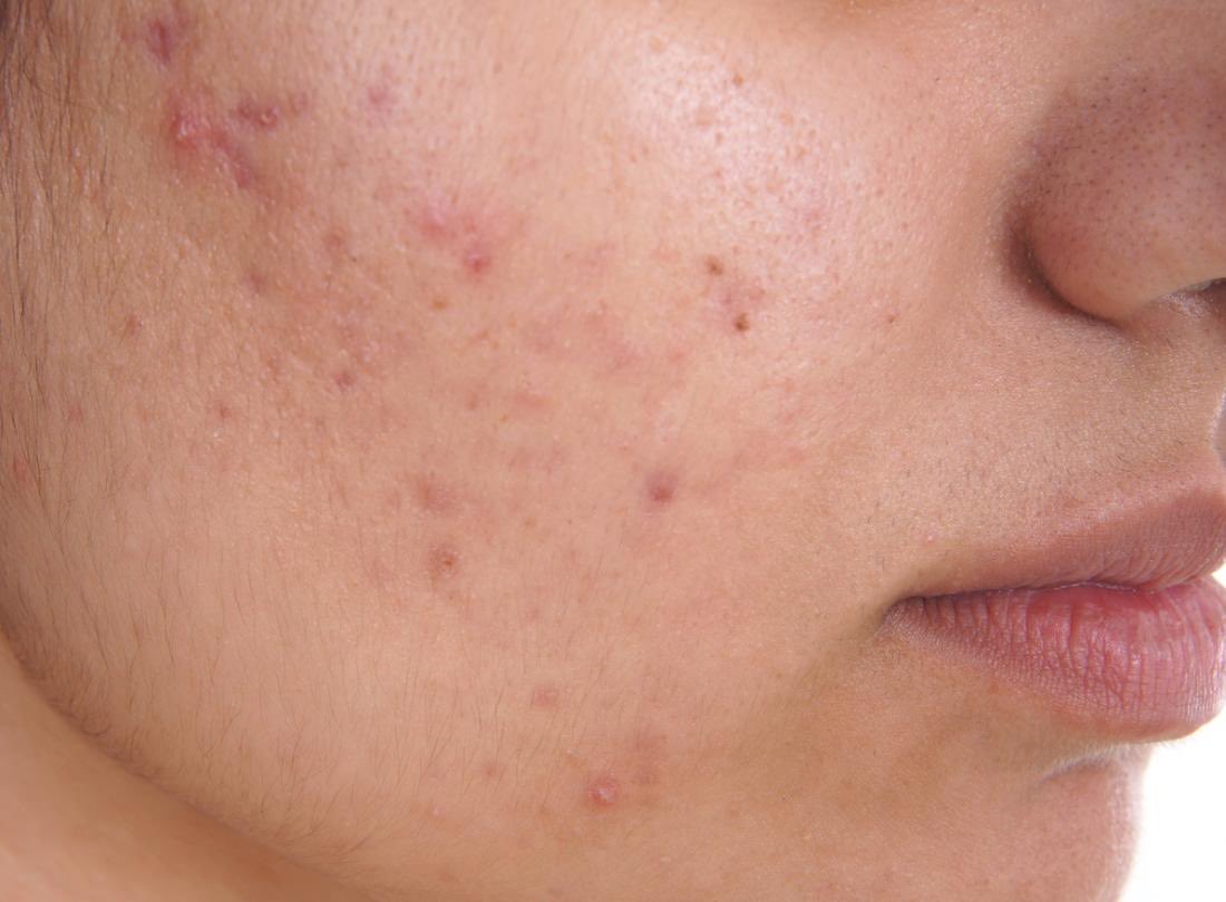 #Acne
🚨 نقطة مهمة قد يُغفل عنها

Avoid oral Abx monotherapy. Always combine with non-Abx topical agents e.g. retinoids or benzoyl peroxide to reduce bacterial resistance 

لاتكتفي بإعطاء مريضك doxycycline 
اضف له benzoyl peroxide معاه