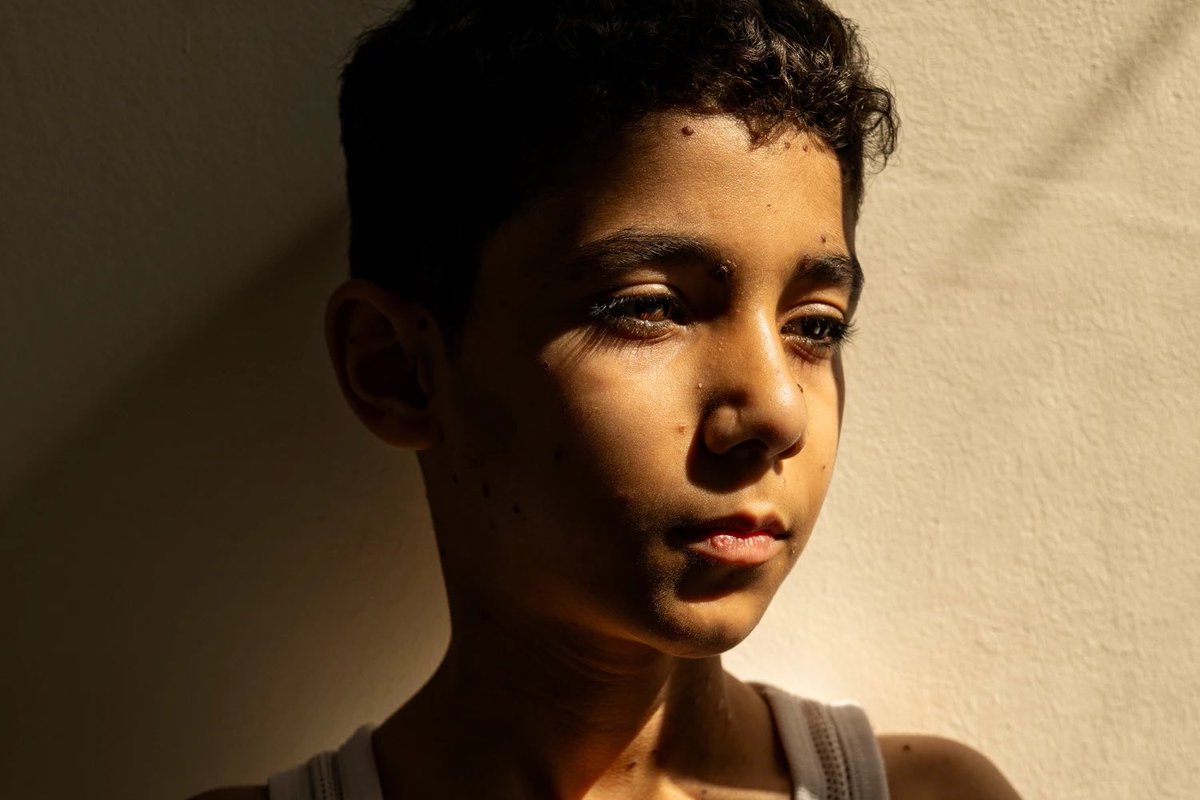 Ha vinto il World Press Photo. E’ il ritratto di Mahmoud Ajjour, un bambino palestinese  che in un attacco a #Gaza ha perso le braccia. Colpisce lo sguardo. 
C’e’ tutta la nostra umanità spezzata.
Sembra chiedere:
“Dove siete?
Perché avete lasciato che accadesse tutto questo?”