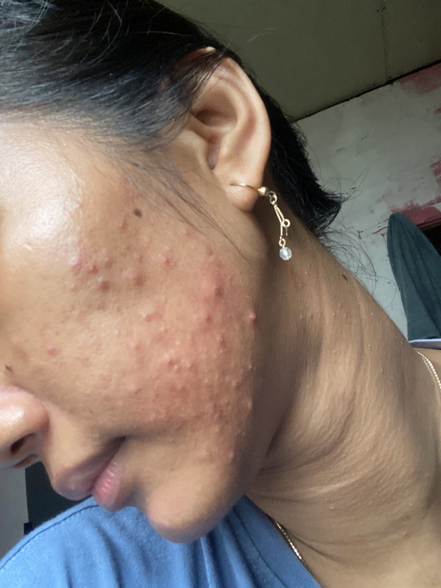 plis kasih tau aku, kalau muka kayak gini harus pake apa😭