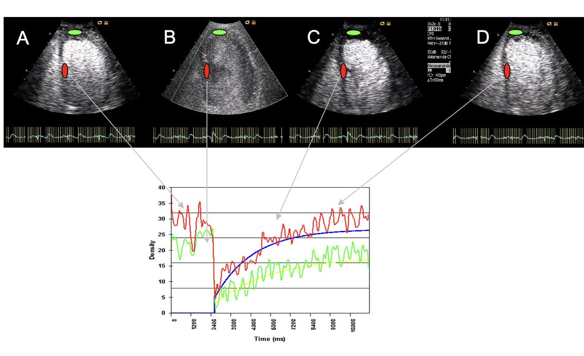 📢Grandes mitos de la ecocardiografia:
Perfusión miocardica con ecocontraste.
📍Ha estádo muy respaldada por la literatura :Comparable a la Medicina nuclear.
 📍En la práctica  su uso es totalmente marginal en la mayoría de los centros.
📍Principales errores:dificultades