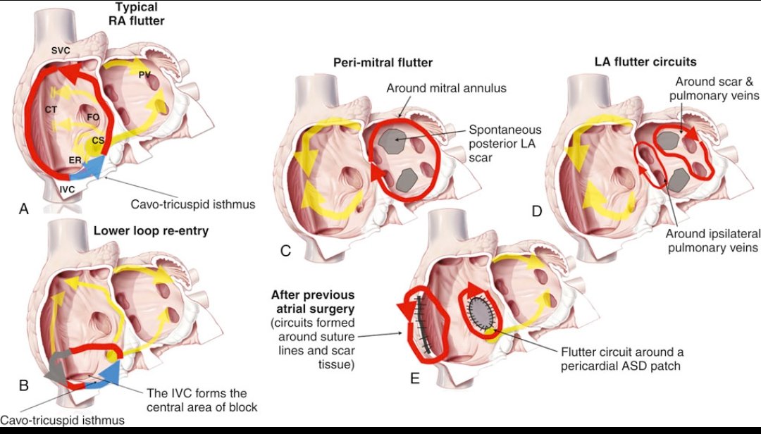 Atrial flutter = macroreentrant atrial tachycardia, classically seen as sawtooth flutter waves on ECG (best in inferior leads). It’s driven by large circuits—often in the RA, but LA circuits are also common post-surgery or ablation.

Types of atrial flutter in the image:

A.