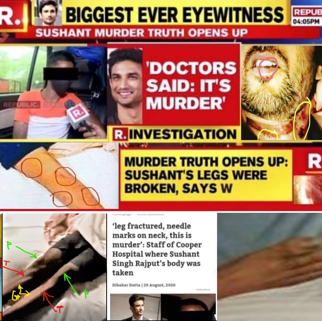 Yasmin2186's tweet photo. SSR body was BADLY BRUISED. Cut Marks On His Legs &amp; Feet, Right Thumb Swollen, Multiple Wounds on Hands, neck area,his Face.

▪︎Legs were broken
▪︎15-20 Needle marks
▪︎Body had turned yellow.

—🚑 Attendant

@CBIHeadquarters 🦜
Hard 2Ignore Facts InSSRCase
#SSRWasMurdered https://t.co/b50ah8ERxC