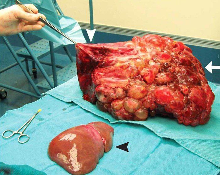 Smart1Doctor1's tweet photo. Polycystic liver (a healthy one is lying nearby for comparison).
.
.
.
.
#PolycysticLiver #LiverHealth #CysticDisease #HealthComparison #MedicalEducation #LiverFunction #PatientAwareness #CysticLesions #Hepatology #HealthInformation #Anatomy #MedicalConditions #Wellness #OrganHealth #HealthTips