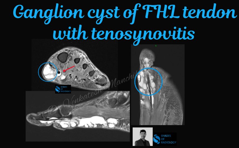 drvenkimdrd's tweet image. FHL Ganglion cyst - Rare case presentation 👇🏻👇🏻
@mskradiologyuk @PrimeFellowship