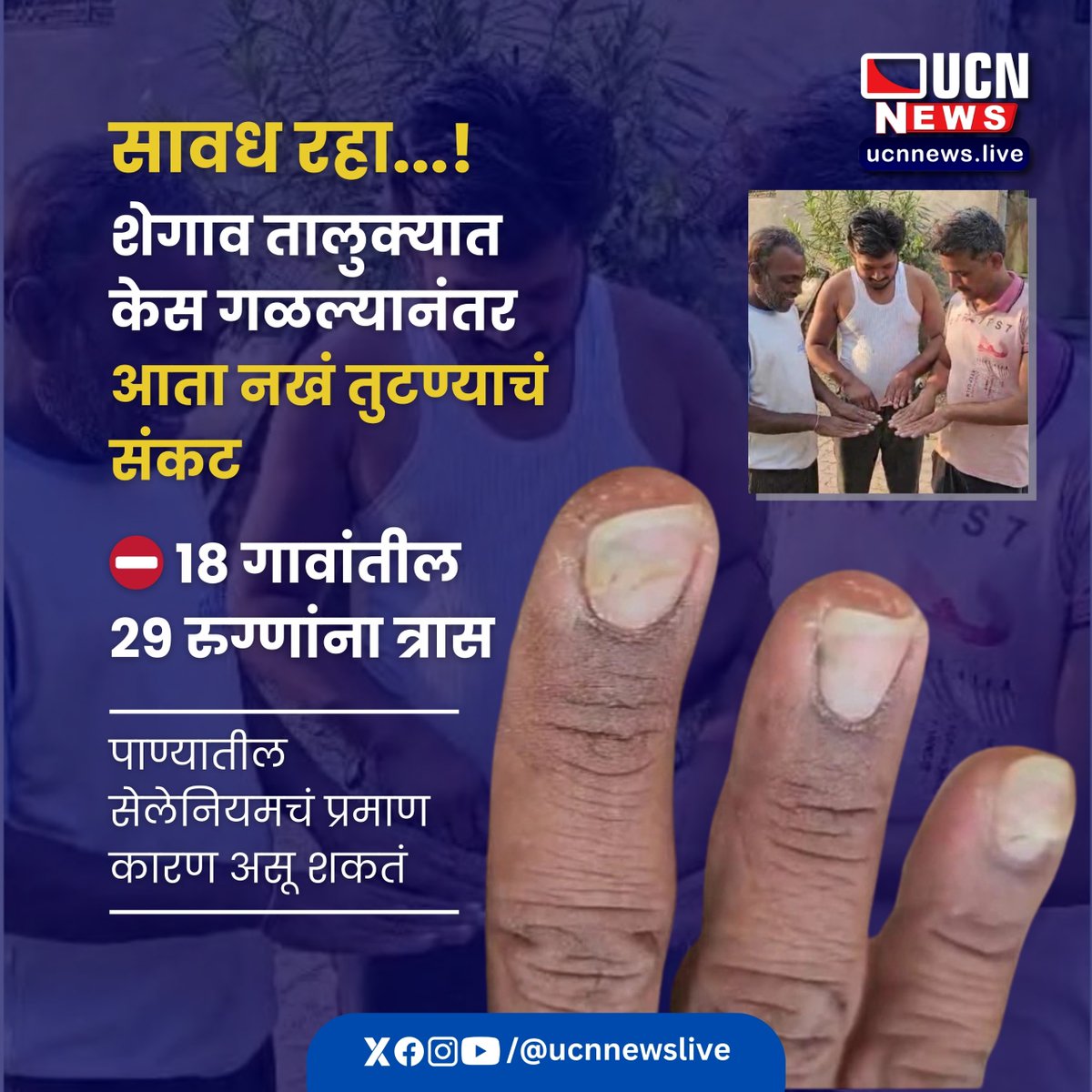 ucnnewslive's tweet image. शेगाव में बालों के बाद अब नाखूनों की समस्या, 29 मरीज प्रभावित

बुलढाणा जिले के शेगाव तालुका में बाल झड़ने के बाद अब नाखून टूटने की समस्या सामने आई है। 29 मरीजों के नाखून बेहद कमजोर हो गए हैं और टूट रहे हैं
#shegaon #hairfall #nailsproblem
#buldhana #waterissues
#updates #ucnnews