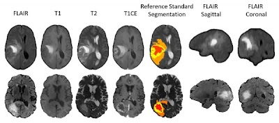 Radiology: Artificial Intelligence (@radiology_ai) on Twitter photo BraTS-Africa Dataset contains 3D MRI scans, from institutions in #Nigeria, of 146 adult patients with preoperative brain tumors doi.org/10.1148/ryai.2… <a href="/AMAdewole/">Maruf Adewole</a> <a href="/RadRudie/">Jeff Rudie, MD PhD</a> <a href="/LUTHofficial/">LUTH</a> #BraTS #dataset #MachineLearning BraTS-Africa Dataset contains 3D MRI scans, from institutions in #Nigeria, of 146 adult patients with preoperative brain tumors doi.org/10.1148/ryai.2… <a href="/AMAdewole/">Maruf Adewole</a> <a href="/RadRudie/">Jeff Rudie, MD PhD</a> <a href="/LUTHofficial/">LUTH</a> #BraTS #dataset #MachineLearning