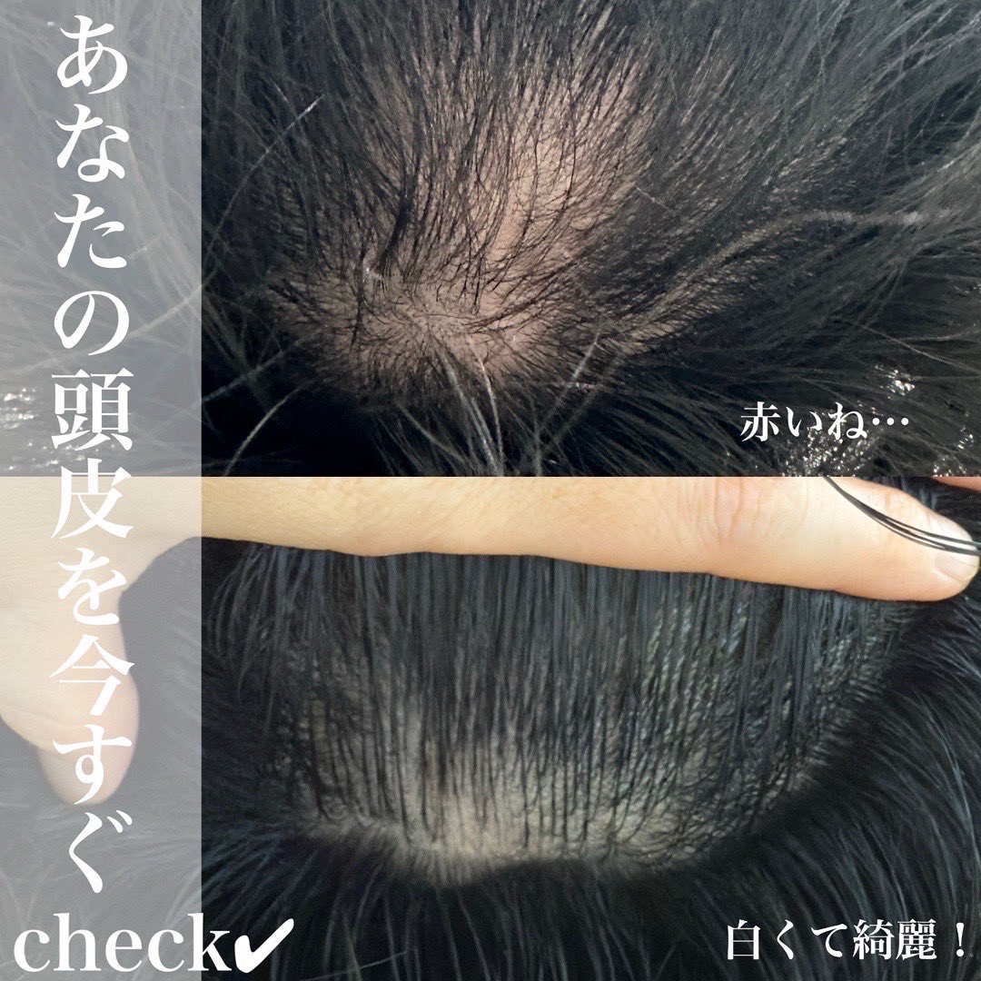 M_LASHcouturier's tweet photo. 🧐突然ですが、頭皮ちぇーーーーーーっく‼️
皆さん、自分の頭頂部、鏡🪞で見て‼️今すぐ‼️

何色だった？

🤍→セーフ
❤️‍🔥→アウト

赤い頭皮は、炎症状態🔥🥵
↓
これは、『ハゲる前兆です』もしくは『すでにハゲてます』

毎日、営業周り頑張ってるあなた👉
ランニング大好きのあなた👉
お子さんのスポーツに付き合うお父さんお母さん👩🧑
シャンプーごしごし、熱いシャワー🚿ぶっかけるあなた👉
うっかり、『炎症対策』できてないんじゃない⁉️

炎症といってもいろいろある事わかったかな⁉️
🔸紫外線
🔸お湯の温度
🔸摩擦
これが原因の場合が多い‼️

お肌に日焼けどめは塗っても…
シャンプーごしごしして熱ーいシャワーで流したら、
頭皮真っ赤よ🔥

『ハゲる』って何でいやかっていうと
🥺老けてみえる
🥹会話中に皆んなの視線が気になる
😭陰でネタにされたら最悪
😖あだ名付けられてた
↓
『プライドずたずた　元気喪失😞』
↓
🔥COALASHは、あなたをそんな気持ちにさせません❤️‍🔥❤️‍🔥❤️‍🔥

ちゃんと育毛プランあるから‼️
『ハゲを防ぐ良いもの』あるの❤️‍🔥

それは…

#ACスカルプトリートメント →サロンケア
初回17.600円税込　　※極上ヘッドスパ付き

と

#リアムール　　→ホームケア
#エキスパートローション　9350円税込
他にもおすすめあり❤️‍🔥
詳細はサロンで🥰

今時、サロンケアとホームケアが大切なのは当たり前❣️

『毎日コツコツしか勝たん❤️‍🔥』

予防と対処　この2つがあれば

【あなたのハゲる未来】は【防げる】‼️🔥🔥🔥

3枚目のお写真の方がどうやって回復❤️‍🩹したか知りたい方は、まずは、COALASH ホットペッパーからご予約して🥰

https://t.co/nAVbrXcShT

@coalash1107 
@coalash1215 

私達がサポートします🥰お待ちしてます✨

お気軽にＤＭください❤️‍🔥
全国の悩める方からお問い合わせたくさんいただいてます✨

#リアボーテオンラインカウンセリング販売実施店 

#はげ
#育毛ケア

マツエク/エステサロン
「COA LASH」(コアラッシュ)
福井県鯖江市水落町2-28-24
◇TEL0778-67-3188 
◇営業時間９時から19時(L.O18:30)
◇土曜日/日曜も営業 
Instagram/ホットペッパービューティー記載店
(line) @bqr1088z