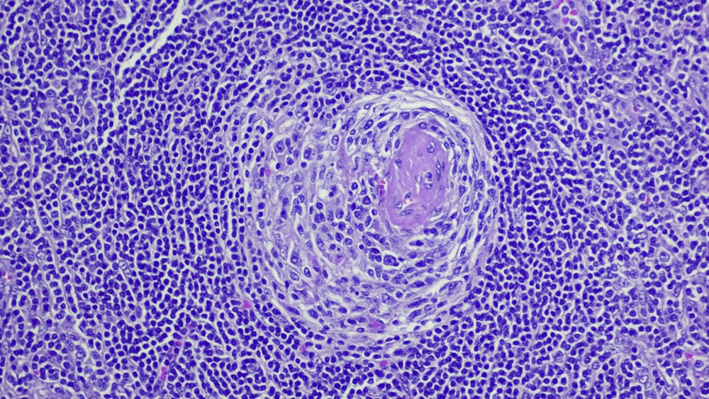 Penn Medicine CSO (@pennmedcso) on Twitter photo For the first time in 45 years, a new subtype of Castleman disease has been identified, allowing patients to receive the right treatment for their condition ft. <a href="/DavidFajgenbaum/">David Fajgenbaum, MD</a> (<a href="/PennMedicine/">Penn Medicine</a>) & <a href="/JBrandMDPhD/">Joshua Brandstadter MD PhD</a> (<a href="/PennCancer/">Penn Medicine - Abramson Cancer Center</a>) <a href="/CureCastleman/">CDCN</a> tinyurl.com/52mjd9az For the first time in 45 years, a new subtype of Castleman disease has been identified, allowing patients to receive the right treatment for their condition ft. <a href="/DavidFajgenbaum/">David Fajgenbaum, MD</a> (<a href="/PennMedicine/">Penn Medicine</a>) & <a href="/JBrandMDPhD/">Joshua Brandstadter MD PhD</a> (<a href="/PennCancer/">Penn Medicine - Abramson Cancer Center</a>) <a href="/CureCastleman/">CDCN</a> tinyurl.com/52mjd9az