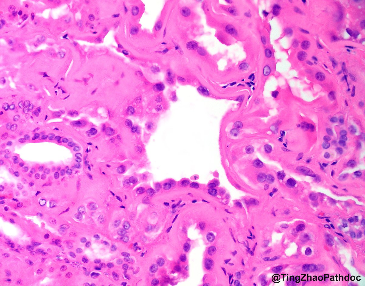 Ting Zhao, MD (@tingzhaopathdoc) on Twitter photo 39 y.o. M, partial nephrectomy. What is your diagnosis?
<a href="/MGBpathology/">Mass General Brigham Pathology</a> <a href="/MGHPathology/">MGH Pathology</a> 39 y.o. M, partial nephrectomy. What is your diagnosis?
<a href="/MGBpathology/">Mass General Brigham Pathology</a> <a href="/MGHPathology/">MGH Pathology</a>