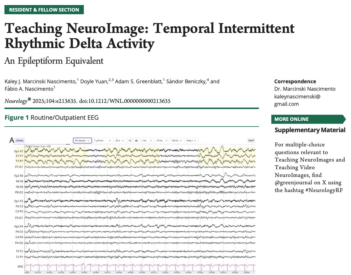 Fábio Nascimento (@fabnascimen) on Twitter photo Temporal Intermittent Rhythmic Delta Activity (TIRDA) should be interpreted as an *epileptiform equivalent*. Great work by <a href="/KNascimenski/">Kaley Marcinski Nascimento</a> & team. 😊📚🧠⚡️
neurology.org/doi/10.1212/WN… Temporal Intermittent Rhythmic Delta Activity (TIRDA) should be interpreted as an *epileptiform equivalent*. Great work by <a href="/KNascimenski/">Kaley Marcinski Nascimento</a> & team. 😊📚🧠⚡️
neurology.org/doi/10.1212/WN…