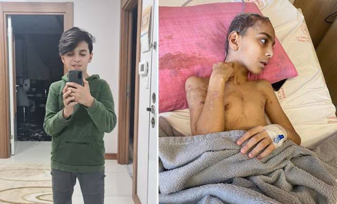 ecekosesi's tweet photo. 40 tane çocuk vefat etti, zorlaya zorlaya köpekleri toplatma yasası çıkardık. Onu da iptal ettirmeye anayasa mahkemesine götürmüşler 7 Mayıs’ta görüşülecekmiş. Şu çocuğun geldiği hale bak. ya Allah Muhammed aşkına bi söyleyin niye 5-10 milyon köpek var ya sokaklarımızda https://t.co/nZTo4TJQTq