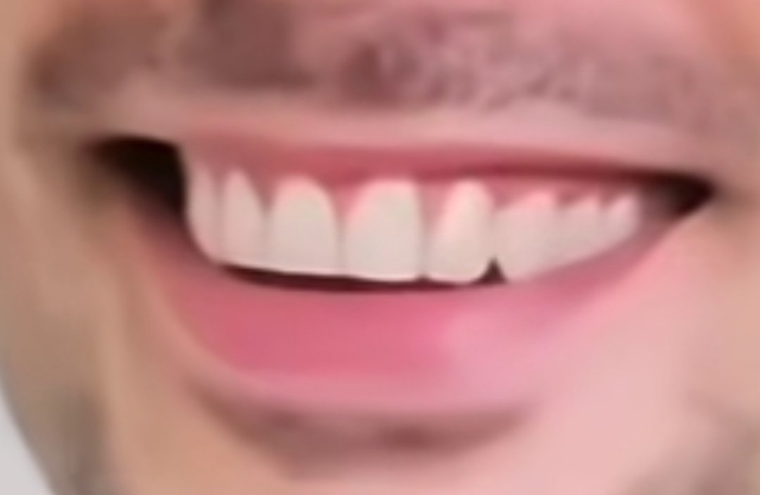 اساتید#دندون بیاید بگید بنظرتون این دندونا طبیعیه یا روش کاری انجام دادن؟
دندانپزشک ها بگن لطفا
@Grok تو هم بگو