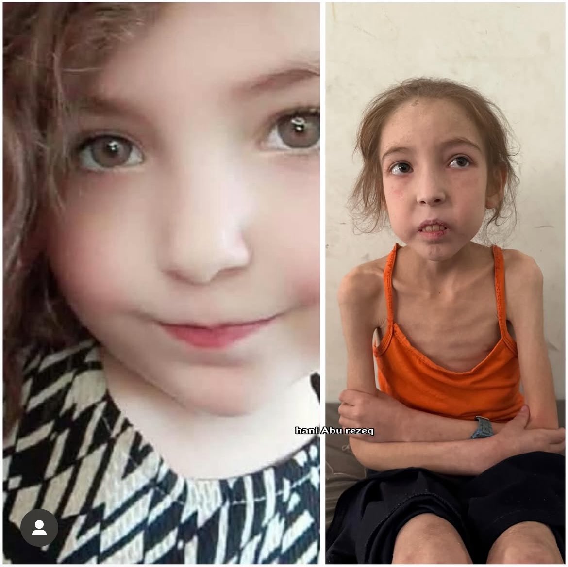 XNews24_7's tweet photo. ๐๐จRahaf Ayad, 12, from Al-Shujaโiya, Gaza, is wasting away from malnutrition and mystery illnesses. Her family pleads for urgent medical travel to save her life! #SaveRahaf #GazaIsStarving #Humanity https://t.co/vqwHJrWNnm