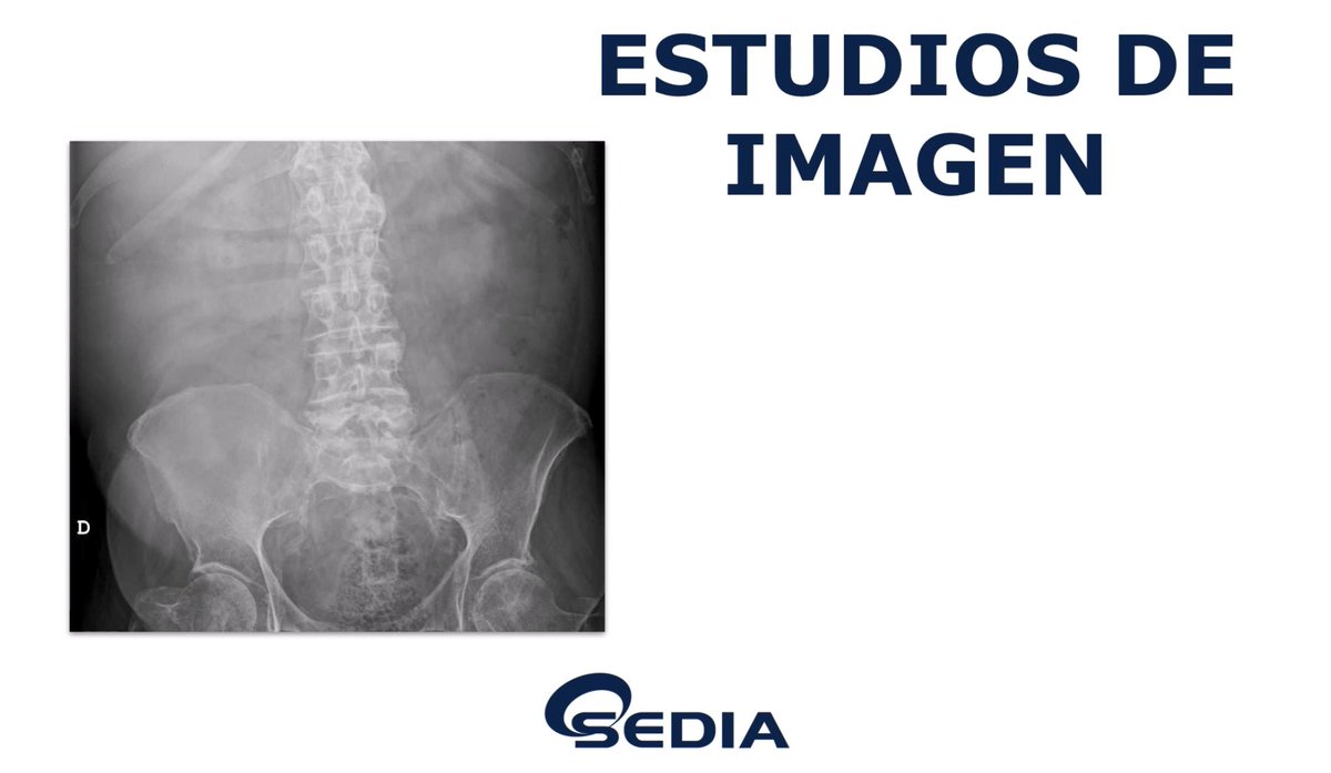 sediabdomen's tweet photo. Disponible #casoSedia de abril:
“Varón de 88 años con dolor abdominal y vómitos. AP: ERC estadio V, en diálisis peritoneal”
¿Cuál es tu diagnóstico diferencial y el diagnóstico más probable?
Anímate y participa‼️
👉🏻Puedes verlo en https://t.co/E4zfMrvZRq https://t.co/phi8F9QB9n