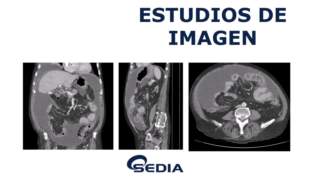 SEDIA (@sediabdomen) on Twitter photo Disponible #casoSedia de abril:
“Varón de 88 años con dolor abdominal y vómitos. AP: ERC estadio V, en diálisis peritoneal”
¿Cuál es tu diagnóstico diferencial y el diagnóstico más probable?
Anímate y participa‼️
👉🏻Puedes verlo en sedia.es/caso-radiologi… Disponible #casoSedia de abril:
“Varón de 88 años con dolor abdominal y vómitos. AP: ERC estadio V, en diálisis peritoneal”
¿Cuál es tu diagnóstico diferencial y el diagnóstico más probable?
Anímate y participa‼️
👉🏻Puedes verlo en sedia.es/caso-radiologi…