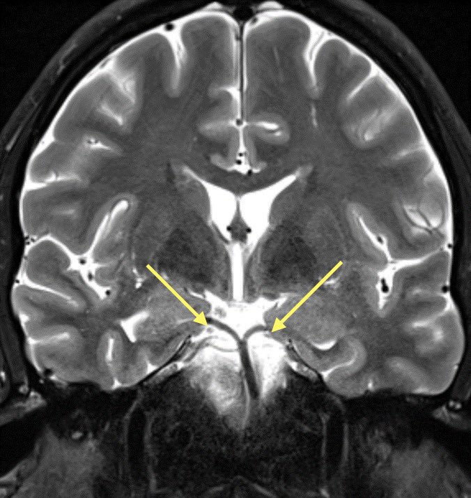 daniel_gewolb's tweet photo. 💡 Oculomotor nerves also run right between the posterior cerebral and superior cerebellar arteries so any aneurysm in this area can also compress the nerve but these locations are much less common than pcom

Oculomotor nerves 🟡 ➡️ https://t.co/ob1zxZIpUX