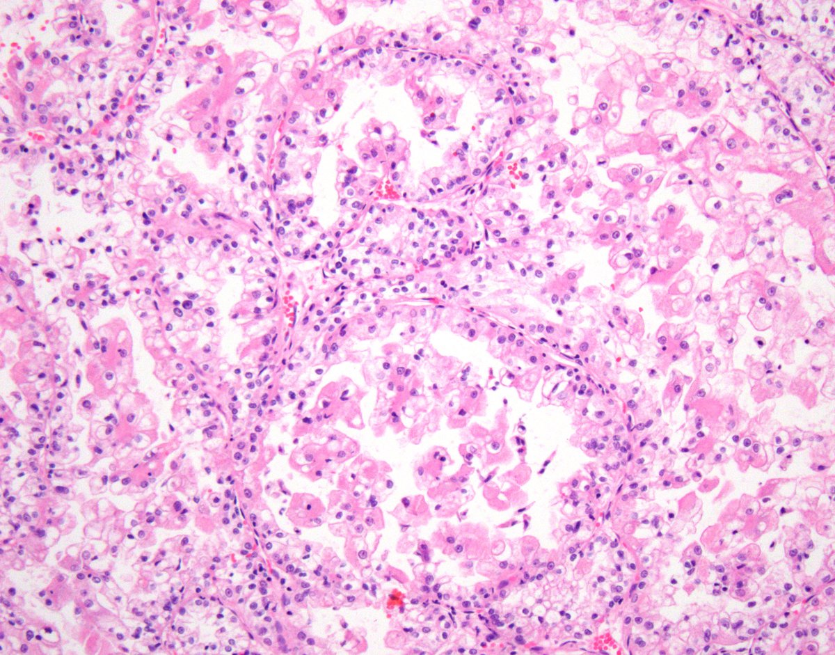 In some Clear Cell RCC, when tumor becomes higher grade, cells become discohesive➡️'pseudo-papillary' appearance #kidneycancer #gupath 

In biopsies, this feature and variable clear to eosinophilic cytoplasm may raise a differential diagnosis which includes MiTF -family RCC
