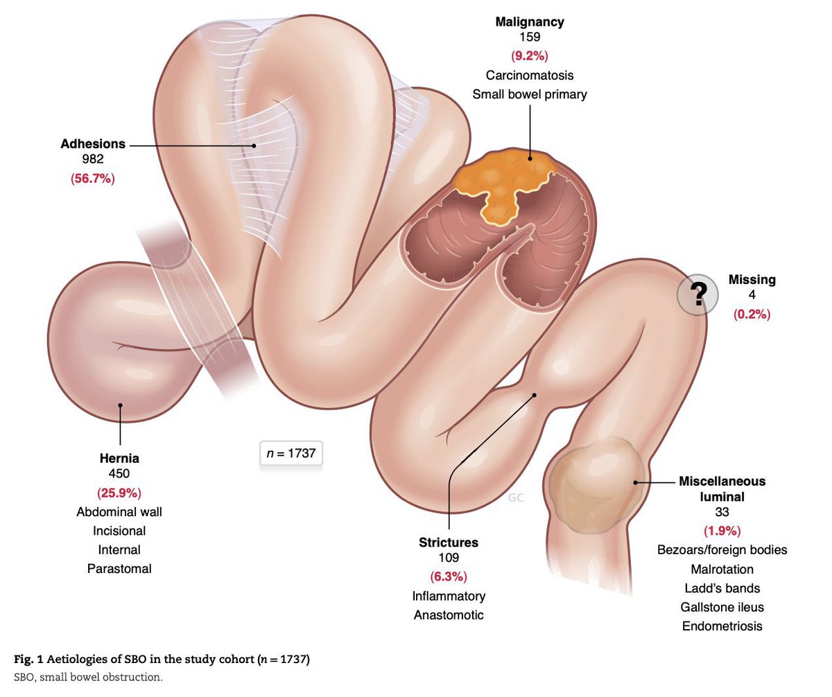 Causes of small bowel obstruction 💡

📸: academic.oup.com/bjs/article/11…