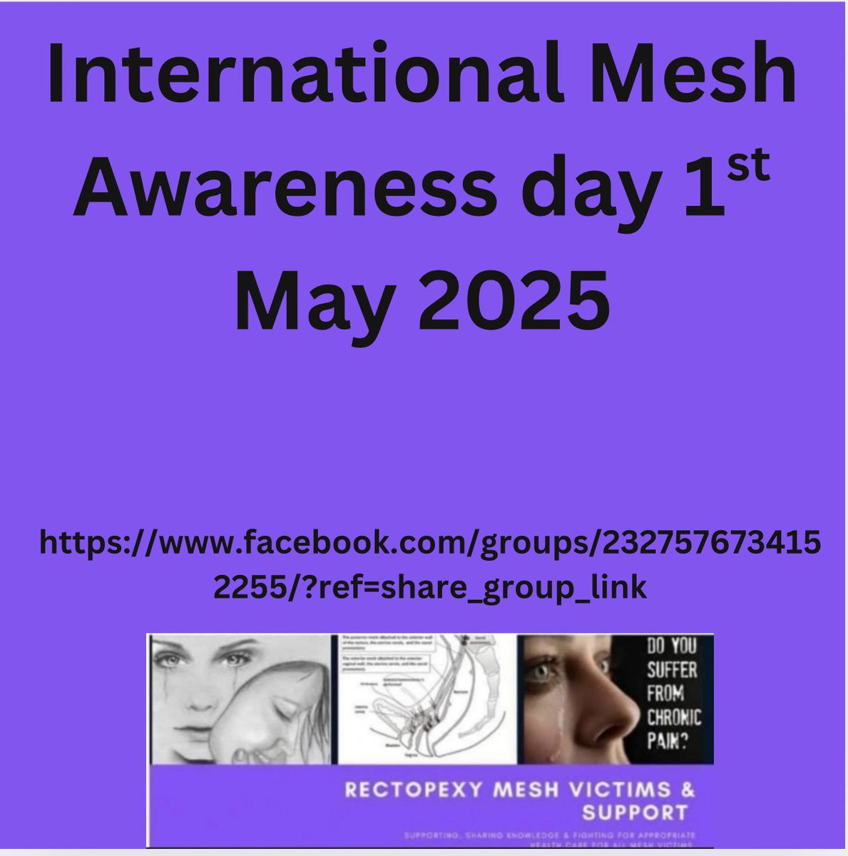 RectopexyS's tweet image. International mesh awareness day we support and stand with all patients affected by mesh complications
Surgical mesh complications affect Men Women and children #mesh #meshcomplications #rectopexy #hernia #pain @sleeblackwell @SkyNews @BBCNews @GBNEWS