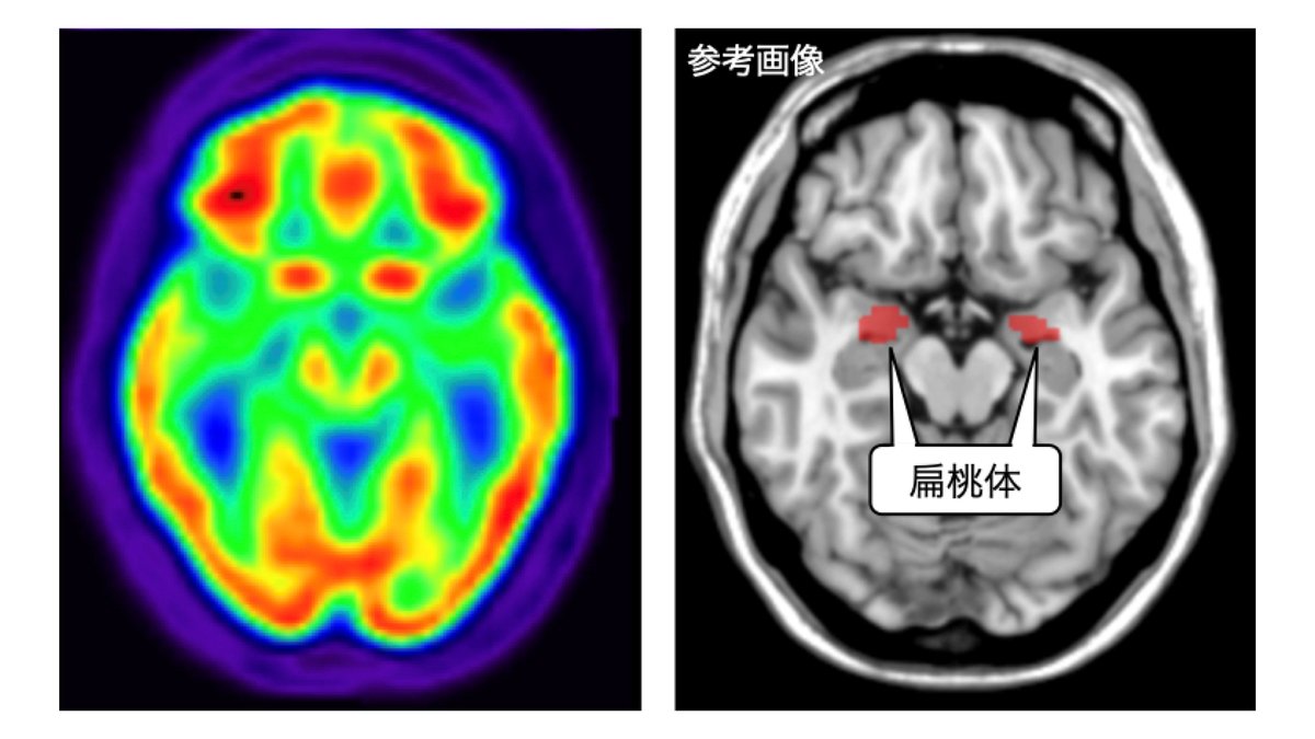 🔬Paper out in Eur J Nucl Med Mol Imaging: "Relation between resting amygdala activity and cardiovascular events in patients with cardiac sarcoidosis" by a research team including #BRI CIHBS scientists. 🫀🧠
bri.niigata-u.ac.jp/en/research/re…