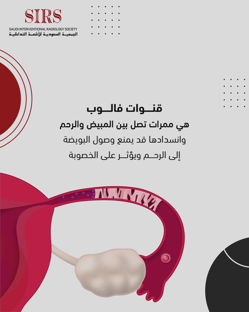 ما هو انسداد قنوات فالوب؟
قنوات فالوب هي الممر الذي يصل بين المبيض والرحم، وعند انسدادها، قد تمنع وصول البويضة، مما يقلل فرص الحمل.
⚠️ الأسباب المحتملة:
  🔹 التهابات الحوض
  🔹 بطانة الرحم المهاجرة
  🔹 التصاقات بعد جراحات سابقة
💡 الحل؟ يمكن فتح القنوات المسدودة بدون جراحة