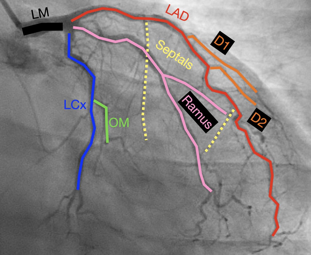 CardiovascularCorner (@trackyourheart) on Twitter photo Which angiographic projection is demonstrated in this image?
(Image courtesy of <a href="/willyhfrick/">Willy Frick</a>) Which angiographic projection is demonstrated in this image?
(Image courtesy of <a href="/willyhfrick/">Willy Frick</a>)