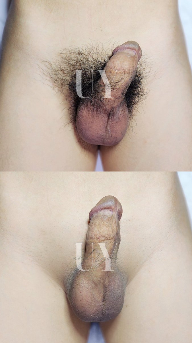 menswaxing_my's tweet photo. 第一次体验男士私密激光除毛，内心 OS 大概是这样：
「会不会痛？要不要尴尬？我到底为什么要来？」
#Boyzilian #LaserHairRemoval #MaleGrooming #MensSelfCare #SmoothDownThere #ButtockLaser #AnusLaser #NoMoreHairDownThere #MensHygiene #男士激光除毛 #男士私密护理 #精致男生日常 https://t.co/B64qGfwLPH