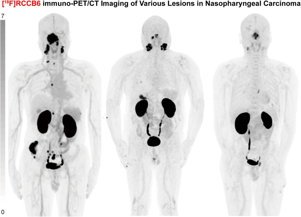 A novel imaging approach for primary and metastatic nasopharyngeal carcinomas. <a href="/JournalofNucMed/">JNM</a> 

CD70-Targeted [18F]RCCB6 Immuno-PET/CT Imaging in Patients with Nasopharyngeal Carcinoma: A Proof-of-Concept Study jnm.snmjournals.org/content/early/…