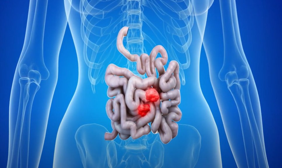 NIHR Oxford Biomedical Research Centre (@oxfordbrc) on Twitter photo Researchers from <a href="/TGU_Oxford/">Translational Gastroenterology & Liver Unit (TGLU)</a> <a href="/Uni_Newcastle/">University of Newcastle</a> <a href="/Uni_Lancashire/">The University of Central Lancashire - UCLan</a> have developed major new guidelines for monitoring patients with #IBD to prevent them going on to develop #BowelCancer
oxfordbrc.nihr.ac.uk/?p=20934 @NIHRResearch <a href="/NIHRNewcBRC/">NIHR Newcastle BRC</a> <a href="/CrohnsColitisUK/">Crohn's & Colitis UK</a> <a href="/NDMOxford/">Nuffield Department of Medicine</a> #Crohns #Colitis Researchers from <a href="/TGU_Oxford/">Translational Gastroenterology & Liver Unit (TGLU)</a> <a href="/Uni_Newcastle/">University of Newcastle</a> <a href="/Uni_Lancashire/">The University of Central Lancashire - UCLan</a> have developed major new guidelines for monitoring patients with #IBD to prevent them going on to develop #BowelCancer
oxfordbrc.nihr.ac.uk/?p=20934 @NIHRResearch <a href="/NIHRNewcBRC/">NIHR Newcastle BRC</a> <a href="/CrohnsColitisUK/">Crohn's & Colitis UK</a> <a href="/NDMOxford/">Nuffield Department of Medicine</a> #Crohns #Colitis
