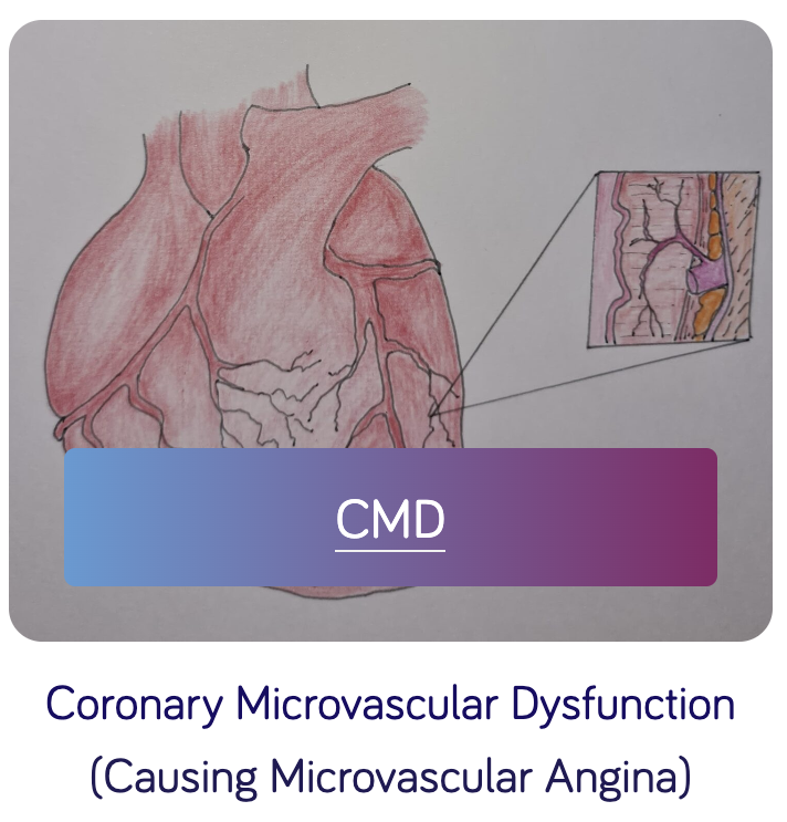 Today we are sharing no.2 of our 4 summary sheet on INOCA conditions -

*Coronary Microvascular Dysfunction*

You can view/download our summary sheets at 
inocainternational.com/what-is-inoca

Please remember to share this post to help spread awareness of INOCA conditions 😊

"THANK YOU!"🥰