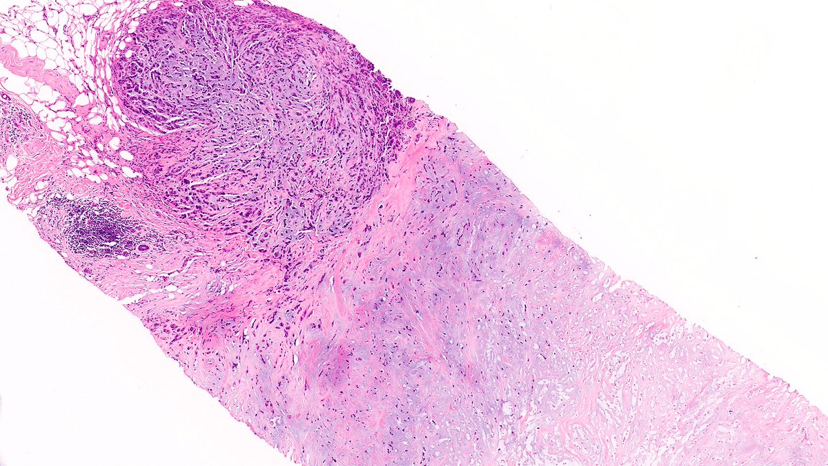 Case of Matrix-Producing Metaplastic Carcinoma 🔬

Historically a subtype of metaplastic carcinomas with mesenchymal elements, matrix-producing metaplastic carcinoma shows abrupt transition of epithelial cells to  chondroid/osteoid matrix.

#PathX #PathTwitter #breastpath