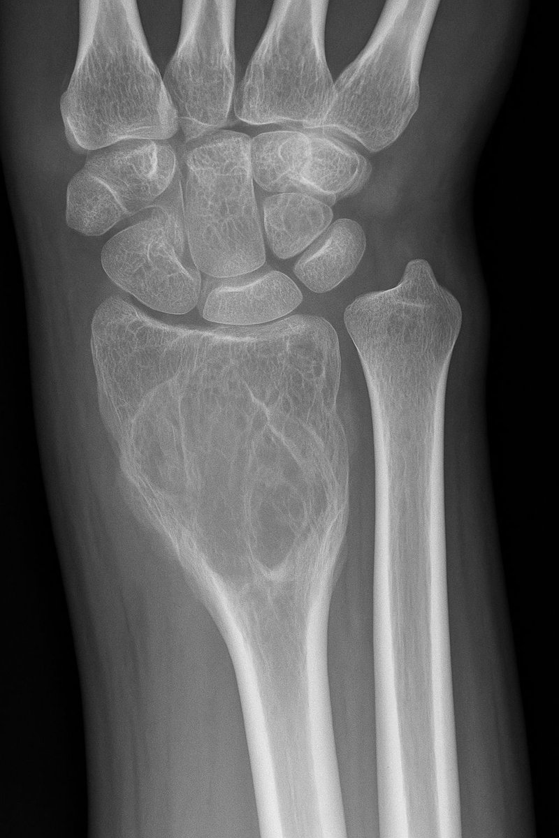 radRounds's tweet photo. Painless and no issues with wrist. Diagnosis? https://t.co/8fKnIihkUw