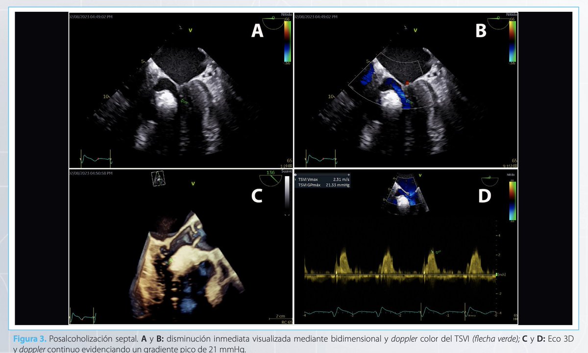 RevistaRetic (@revistaretic) on Twitter photo Alcoholización septal en miocardiopatía hipertrófica obstructiva. Tinción septal con solución salina...
Una nueva revisión espectacular ✌️✌️✌️✌️✌️✌️
imagenretic.org/RevEcocarPract…
<a href="/MAecocardio/">MA Garcia Fernandez</a> <a href="/SISIACOficial/">SISIAC</a> <a href="/Azcarate_Cardio/">Doctor Pedro Azcárate</a> <a href="/josejgdnews/">Jose Juan Gomez</a> <a href="/rafavidalperez/">rafavidalperez</a> <a href="/javierurmeneta1/">Javier Urmeneta</a> Alcoholización septal en miocardiopatía hipertrófica obstructiva. Tinción septal con solución salina...
Una nueva revisión espectacular ✌️✌️✌️✌️✌️✌️
imagenretic.org/RevEcocarPract…
<a href="/MAecocardio/">MA Garcia Fernandez</a> <a href="/SISIACOficial/">SISIAC</a> <a href="/Azcarate_Cardio/">Doctor Pedro Azcárate</a> <a href="/josejgdnews/">Jose Juan Gomez</a> <a href="/rafavidalperez/">rafavidalperez</a> <a href="/javierurmeneta1/">Javier Urmeneta</a>