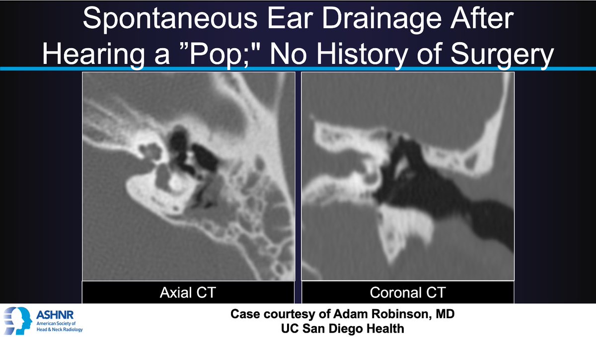 ASHNR (@ashnrsociety) on Twitter photo #ASHNRCOTW #295: Ear "pop". Thx Dr. Robinson 4 case! #ASHNR25
Answer w/ appropriate GIF only -- stay professional & don't spoil it!
<a href="/callyrobs/">Caroline Robson, MBChB</a> <a href="/DShatzkes/">Deborah Shatzkes</a> <a href="/CDP_Rad/">C Douglas Phillips 🇺🇸</a> <a href="/rhwiggins/">Richard Wiggins</a>
<a href="/nakoontz/">Nicholas Koontz</a> <a href="/KRileyMD/">Kalen Riley</a> <a href="/CMGlastonbury/">Christine M Glastonbury, MD</a> <a href="/tabby_kennedy/">Tabby A. Kennedy, MD</a> <a href="/PhilipRChapman1/">Philip R. Chapman, MD</a> <a href="/cmtomblinson/">Courtney Tomblinson, MD</a>
<a href="/amyfjuliano/">Amy Juliano</a> #ASHNRCOTW #295: Ear "pop". Thx Dr. Robinson 4 case! #ASHNR25
Answer w/ appropriate GIF only -- stay professional & don't spoil it!
<a href="/callyrobs/">Caroline Robson, MBChB</a> <a href="/DShatzkes/">Deborah Shatzkes</a> <a href="/CDP_Rad/">C Douglas Phillips 🇺🇸</a> <a href="/rhwiggins/">Richard Wiggins</a>
<a href="/nakoontz/">Nicholas Koontz</a> <a href="/KRileyMD/">Kalen Riley</a> <a href="/CMGlastonbury/">Christine M Glastonbury, MD</a> <a href="/tabby_kennedy/">Tabby A. Kennedy, MD</a> <a href="/PhilipRChapman1/">Philip R. Chapman, MD</a> <a href="/cmtomblinson/">Courtney Tomblinson, MD</a>
<a href="/amyfjuliano/">Amy Juliano</a>