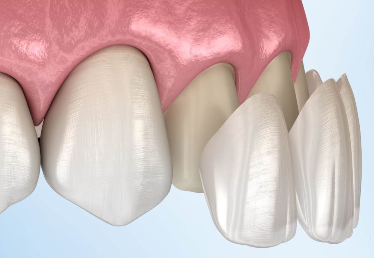 Dentagama's tweet photo. The Benefits of Porcelain Veneers
https://t.co/kYT5pC2uov https://t.co/7DKho71u1A