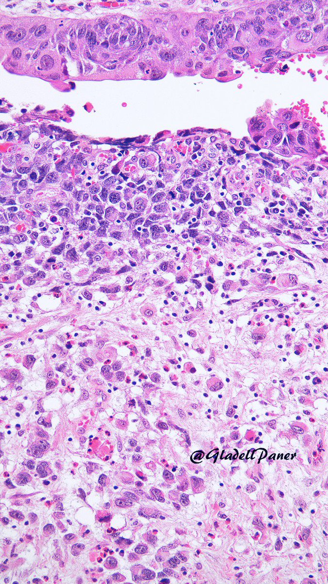 A nice challenge for #GUPath enthusiasts🕵️‍♂️

What is your diagnosis on this adult #urinarybladder TUR with unusual features? #OnePicDx 

Answer and clues in comment 👇👇👇