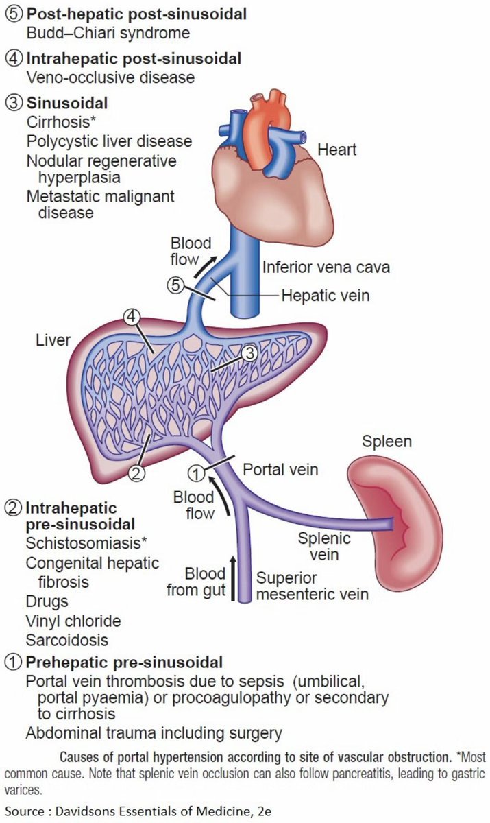 Causes of Portal Hypertension