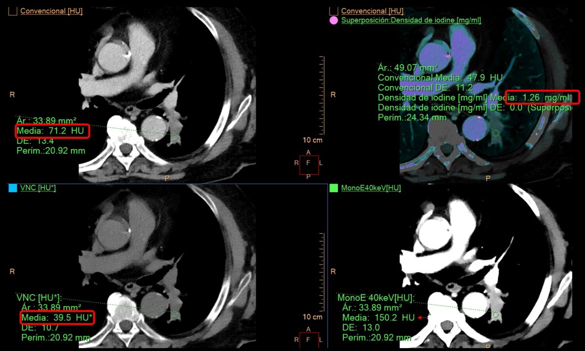 Ana Villanueva (@anavillanuevaca) on Twitter photo Attention to #spectral images! <a href="/CtSpectral/">Gopal Punjabi</a>
⚠️ The endobronchial content is enhancing --> solid!
1️⃣Virtual non-contrast (VNC)= 39HU
2️⃣Conventional= 71UH (>20UH compared to VNC)
3️⃣ Iodine density =1.26 mg/ml Attention to #spectral images! <a href="/CtSpectral/">Gopal Punjabi</a>
⚠️ The endobronchial content is enhancing --> solid!
1️⃣Virtual non-contrast (VNC)= 39HU
2️⃣Conventional= 71UH (>20UH compared to VNC)
3️⃣ Iodine density =1.26 mg/ml