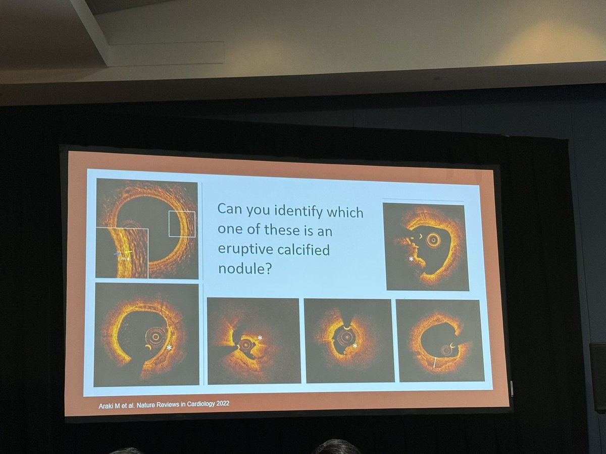 Dhiran_Verghese's tweet image. 🔥  Starting the day with an outstanding session on Calcium Management in Complex Cases 

Experts breaking down the data &amp;amp; sharing key strategies for tackling the toughest scenarios !!!

@DougDrachmanMD @AdhirShroff @SripalBangalore @nadia_sutton 

#SCAI2025 #SoMe
 @SCAI @MyJSCAI