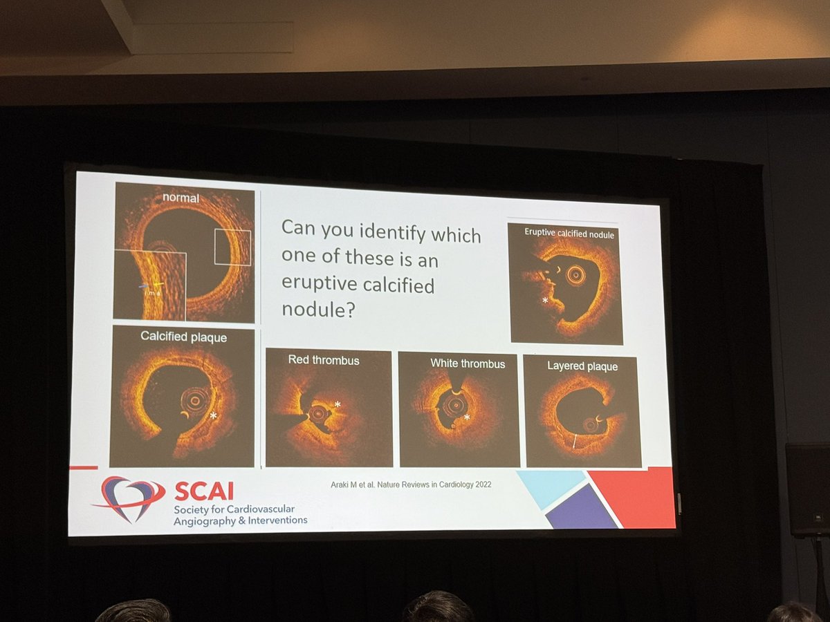 Dhiran Verghese (@dhiran_verghese) on Twitter photo 🔥 Starting the day with an outstanding session on Calcium Management in Complex Cases
Experts breaking down the data & sharing key strategies for tackling the toughest scenarios !!!
<a href="/DougDrachmanMD/">Douglas Drachman</a> <a href="/AdhirShroff/">Adhir Shroff</a> <a href="/SripalBangalore/">Sripal Bangalore</a> <a href="/nadia_sutton/">Nadia Sutton</a>
#SCAI2025 #SoMe
<a href="/SCAI/">SCAI</a> <a href="/MyJSCAI/">MyJSCAI</a> 🔥 Starting the day with an outstanding session on Calcium Management in Complex Cases
Experts breaking down the data & sharing key strategies for tackling the toughest scenarios !!!
<a href="/DougDrachmanMD/">Douglas Drachman</a> <a href="/AdhirShroff/">Adhir Shroff</a> <a href="/SripalBangalore/">Sripal Bangalore</a> <a href="/nadia_sutton/">Nadia Sutton</a>
#SCAI2025 #SoMe
<a href="/SCAI/">SCAI</a> <a href="/MyJSCAI/">MyJSCAI</a>