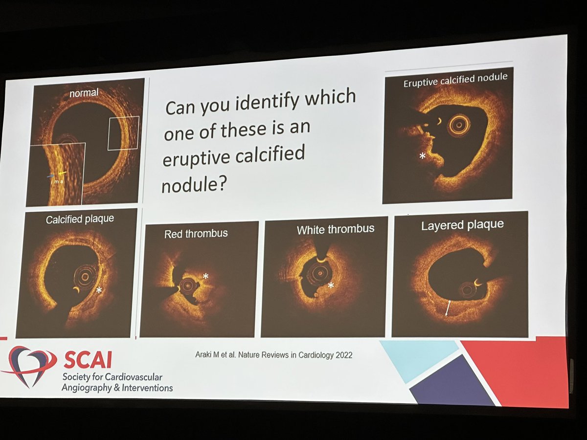 zheng_md's tweet image. So excited to be at #SCAI2025 and part of incredible #SCAI FellowsSummit!
Learning never stops—especially when you’re surrounded by the best in interventional cardiology!
#InterventionalCardiology @MontefioreNYC @nadia_sutton @AdhirShroff @DougDrachmanMD @SripalBangalore