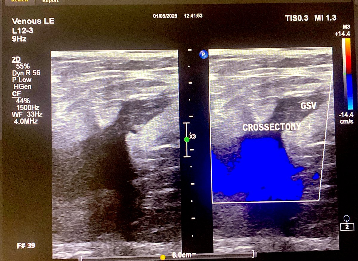 markzroland's tweet photo. Laser Crossectomy Endovenous Laser Ablation in C5 - dominant accessory superficial vein reflux #endovenouslaserablation #EVLA #chronicvenousinsufficiency https://t.co/nFJJLPo3T2