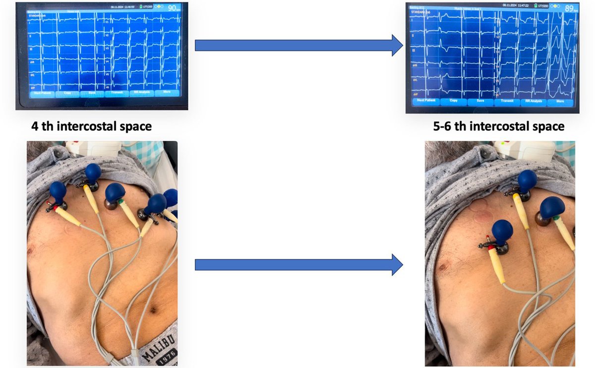 Heart Rhythm Case Reports (@hrs_casereports) on Twitter photo Optimizing R Wave Visualization in Left Bundle Branch Area Pacing: The Role of Lower Intercostal Spaces V1 Placements
<a href="/tahawking/">Ahmet Taha Sahin, MD</a>, <a href="/neutipfakultesi/">NEÜ Tıp Fakültesi</a>
heartrhythmcasereports.com/article/S2214-… Optimizing R Wave Visualization in Left Bundle Branch Area Pacing: The Role of Lower Intercostal Spaces V1 Placements
<a href="/tahawking/">Ahmet Taha Sahin, MD</a>, <a href="/neutipfakultesi/">NEÜ Tıp Fakültesi</a>
heartrhythmcasereports.com/article/S2214-…
