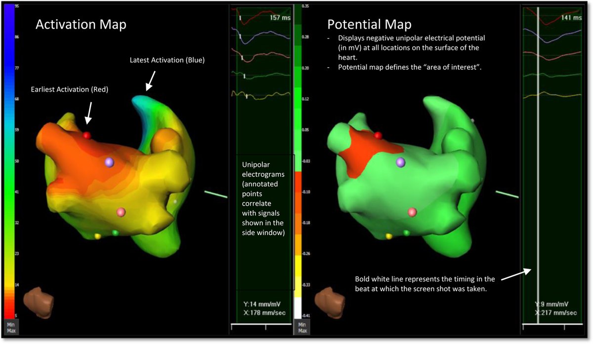 Heart Rhythm Case Reports (@hrs_casereports) on Twitter photo A Novel Approach to Target A Challenging Arrhythmia: Noninvasive ECGi Mapping Guided Ablation of Swallowing Induced Atrial Tachycardia
<a href="/BatulAtiqa/">Atiqa Batul</a>, <a href="/GeisingerHealth/">Geisinger</a>, <a href="/jskoruth/">Jacob Koruth</a>, <a href="/IcahnMountSinai/">Icahn School of Medicine at Mount Sinai</a>
heartrhythmcasereports.com/article/S2214-… A Novel Approach to Target A Challenging Arrhythmia: Noninvasive ECGi Mapping Guided Ablation of Swallowing Induced Atrial Tachycardia
<a href="/BatulAtiqa/">Atiqa Batul</a>, <a href="/GeisingerHealth/">Geisinger</a>, <a href="/jskoruth/">Jacob Koruth</a>, <a href="/IcahnMountSinai/">Icahn School of Medicine at Mount Sinai</a>
heartrhythmcasereports.com/article/S2214-…