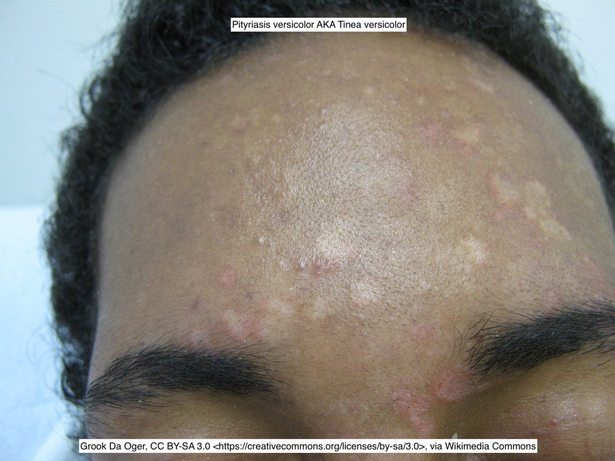 Path4People's tweet image. Can we talk about the confusion of Malassezia species 🍝 😵‍💫 

It&apos;s normal flora in skin and loves Olive 🫒 oil.

But when it overgrows it&apos;s called Pityriasis versicolor AND/OR Tinea versicolor.

Why not just call it Malassezia versicolor?  🫤 🤷 

#pathx #medx #fammed #dermpath